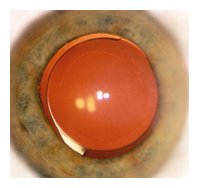 IOL power calculations arizona eye surgeon