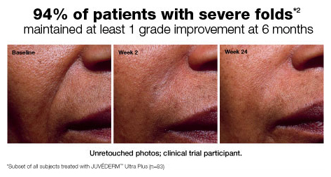 juvederm injections tempe arizona