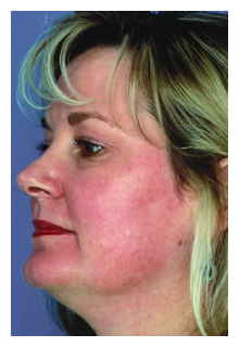 obagi blue peel, obagi nu-derm, obagi, the red spa, cynthia mizgala md facs