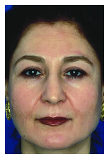 obagi blue peel, obagi nu-derm, obagi, the red spa, cynthia mizgala md facs