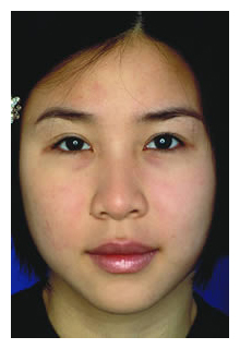 obagi blue peel, obagi nu-derm, obagi, the red spa, cynthia mizgala md facs