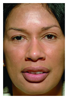obagi blue peel, obagi nu-derm, obagi, the red spa, cynthia mizgala md facs