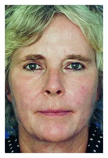 obagi blue peel, obagi nu-derm, obagi, the red spa, cynthia mizgala md facs