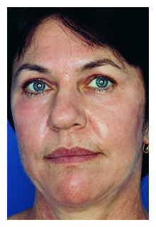 obagi blue peel, obagi nu-derm, obagi, the red spa, cynthia mizgala md facs