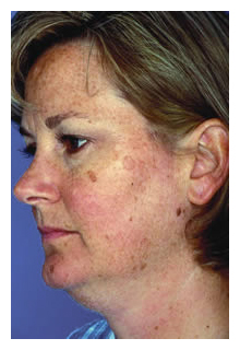 obagi blue peel, obagi nu-derm, obagi, the red spa, cynthia mizgala md facs