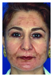 obagi blue peel, obagi nu-derm, obagi, the red spa, cynthia mizgala md facs