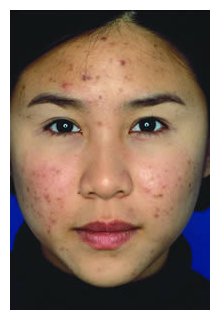 obagi blue peel, obagi nu-derm, obagi, the red spa, cynthia mizgala md facs