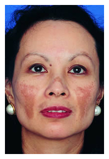 obagi blue peel, obagi nu-derm, obagi, the red spa, cynthia mizgala md facs