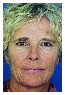 obagi blue peel, obagi nu-derm, obagi, the red spa, cynthia mizgala md facs