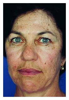 obagi blue peel, obagi nu-derm, obagi, the red spa, cynthia mizgala md facs