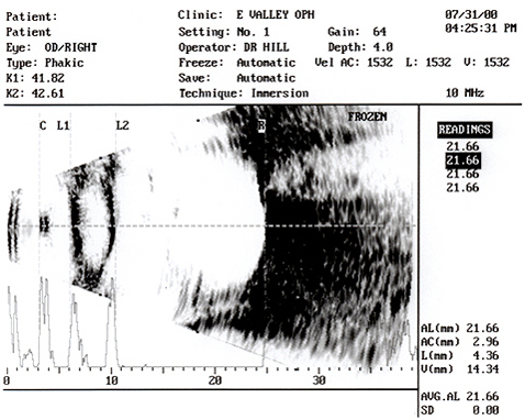 immersion a-scan - iol power calculations
