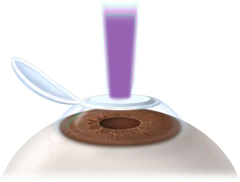 iol calculation after lasik