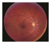 silicone oil inside eye - iol power calculations