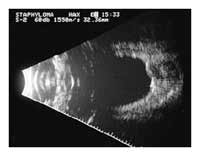 staphylma - iol power calculations
