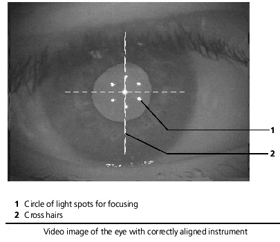 Cataract Surgery Arizona