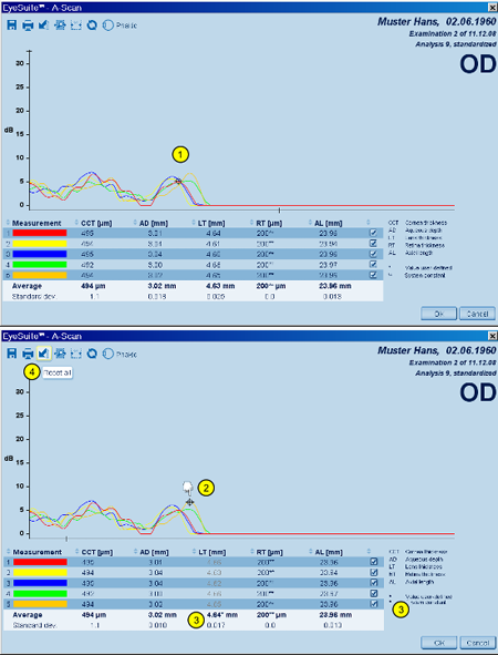 A-scan Details Manual Gate LENSTAR Biometry