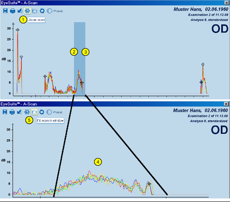A-scan Details Zoom LENSTAR Biometry