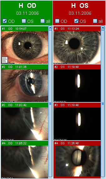 OD OS LENSTAR Operation Imaging