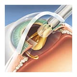 alcon lens implant arizona