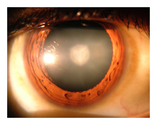 arizona cataract surgery