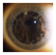 corneal transplantation arizona
