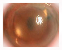 corneal transplantation arizona