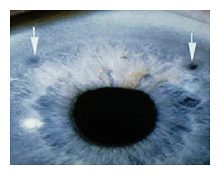 glaucoma specialist arizona iridotomy