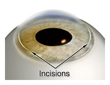 limbal relaxing incisions surgical correction of astigmatism