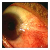 corneal transplantation arizona