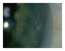 floaters flashes arizona eye doctor