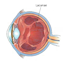 vitreous detachment arizona eye doctor