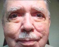 Patient 4 After Eyelid Surgery Mesa Arizona