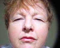 Patient 5 Before Plastic Surgery Mesa Arizona