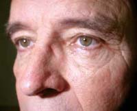 Patient 3 After Eyelid Surgery Mesa Arizona