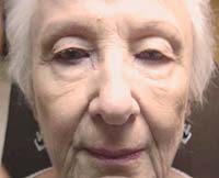 Patient 6 Before Plastic Surgery Mesa Arizona