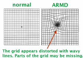Macular Degeneration Chandler