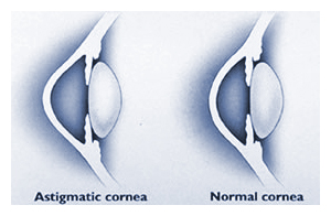 surgical correction of astigmatism