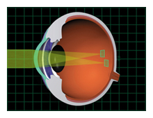 surgical correction of astigmatism