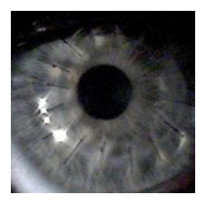 cornea transplant arizona