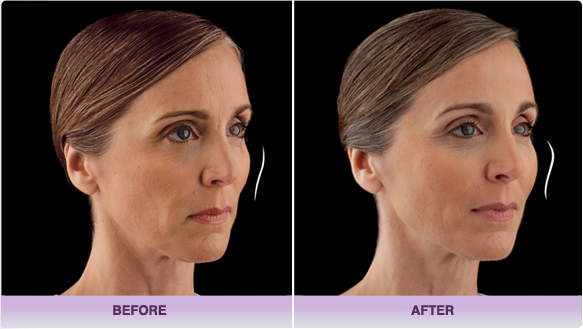 JUV&eacute;DERM VOLUMA™ XC after and before