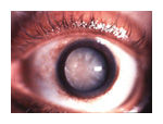 arizona eye surgery cataract