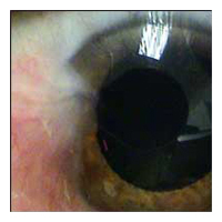 corneal transplantation arizona