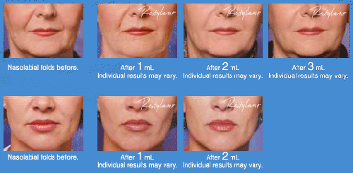 Restylane Facial Fillers Mesa Arizona