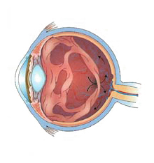 vitreous detachment arizona eye doctor