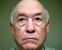 Patient 7 Before Plastic Surgery Mesa Arizona