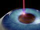 IOL Power after LASIK, PRK, RK