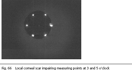 IOLMaster KERATOMETER software